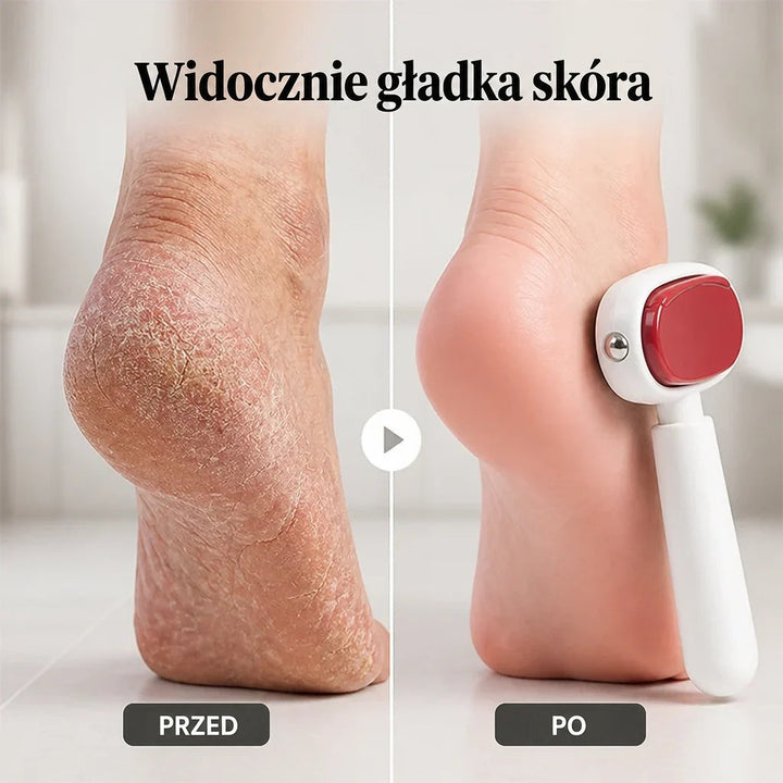 Porównanie pięty przed i po użyciu pilnika: spierzchnięta skóra po lewej, gładka po prawej 2